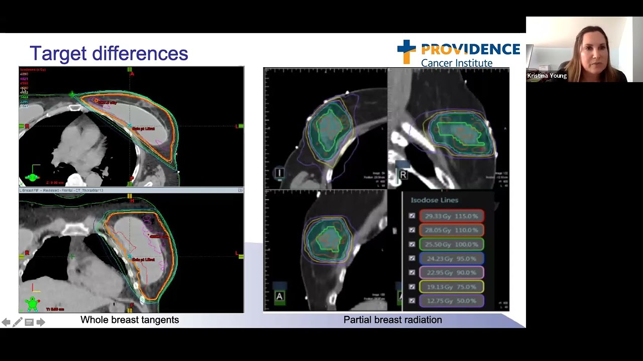 MRI-Guided Radiation Therapy with Dr. Kristina Young