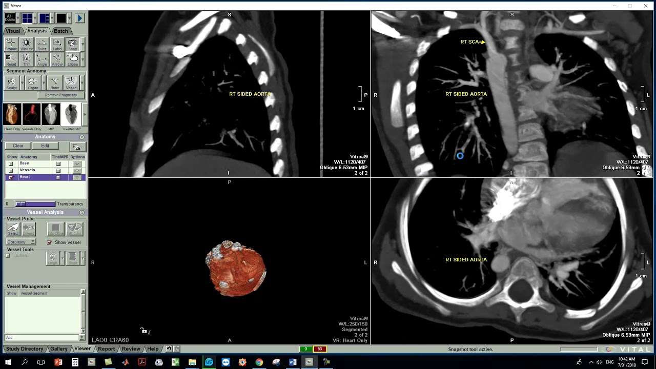 TOF POST PROCESSING UPON  VITREA 6
