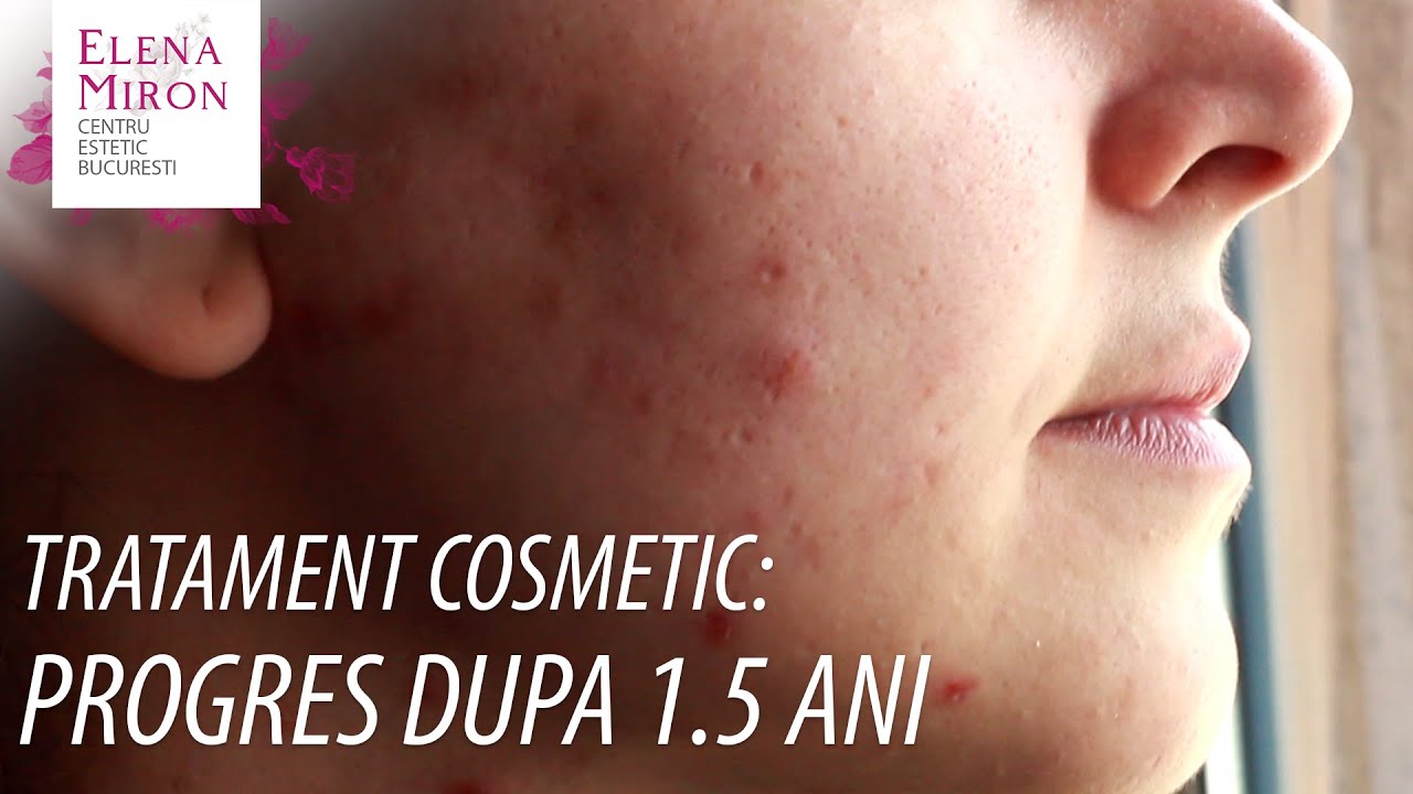 Cosmetica: Tratare Acnee - Progres dupa 18 luni - @Elena Miron București ​