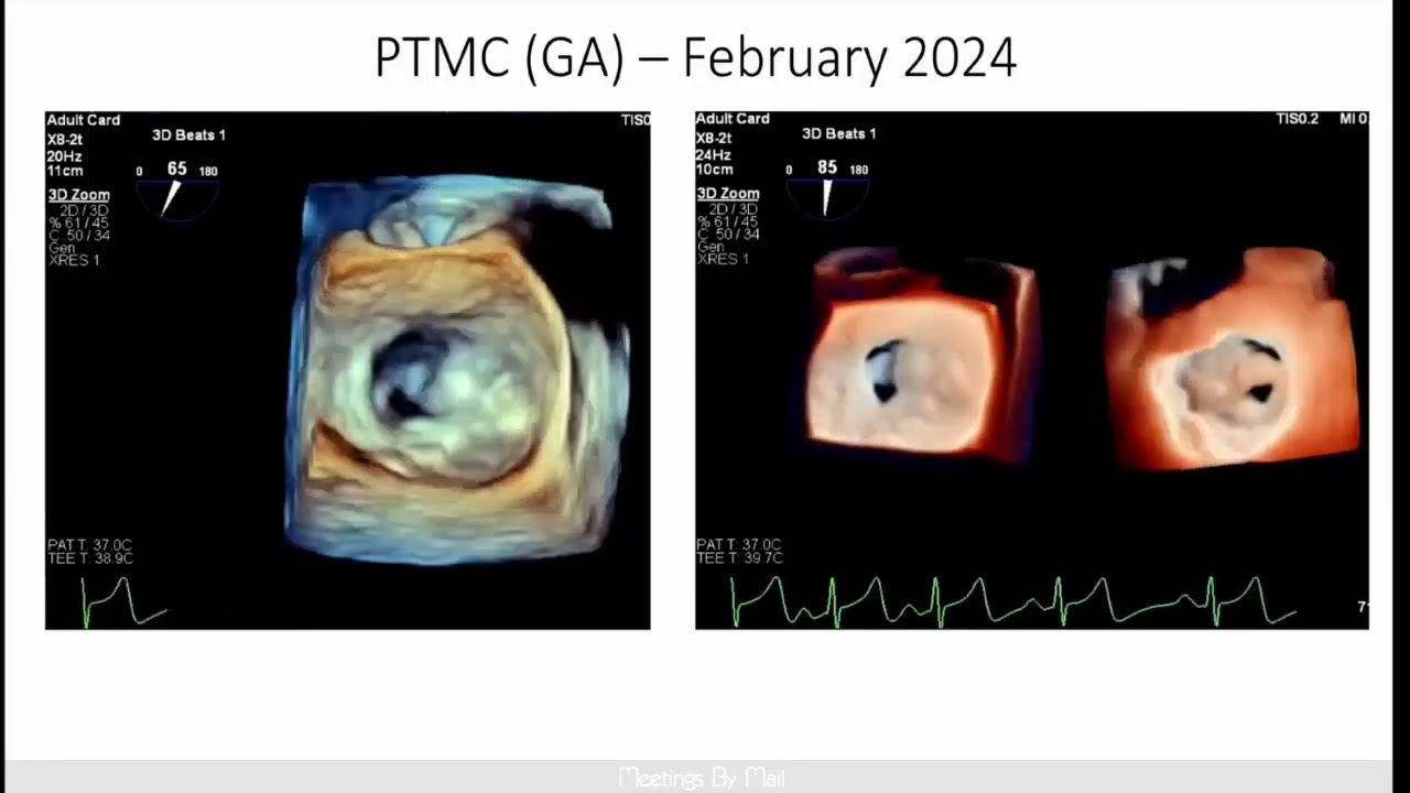 Mitral Valvuloplasty case Medstudylab.com