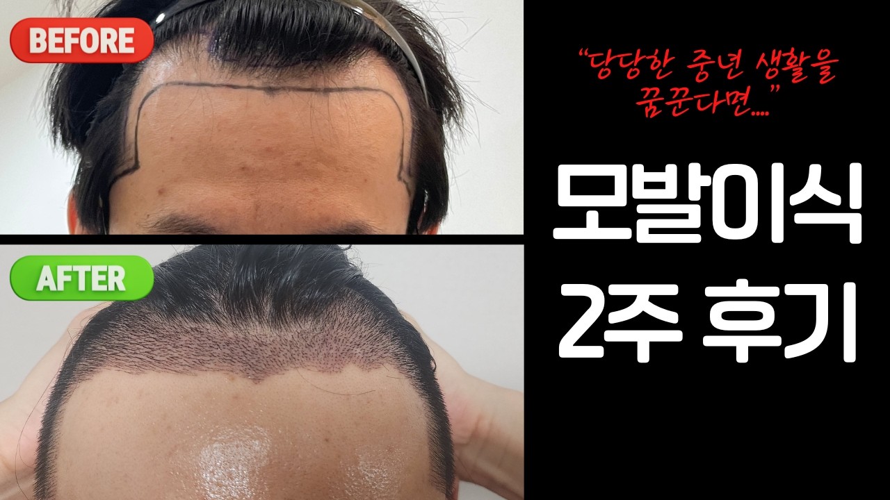 탈모 남성 모발이식 2주 후기 (6700모)