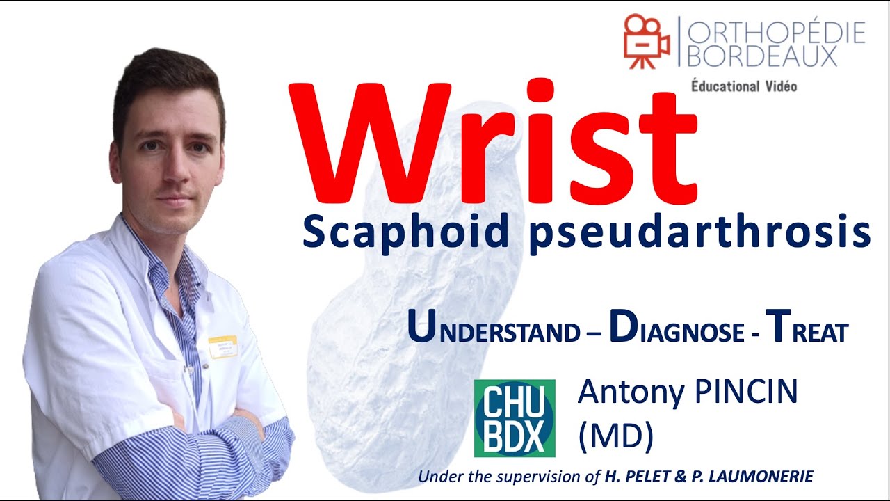 Pseudarthrose du scaphoïde par le Dr Pincin