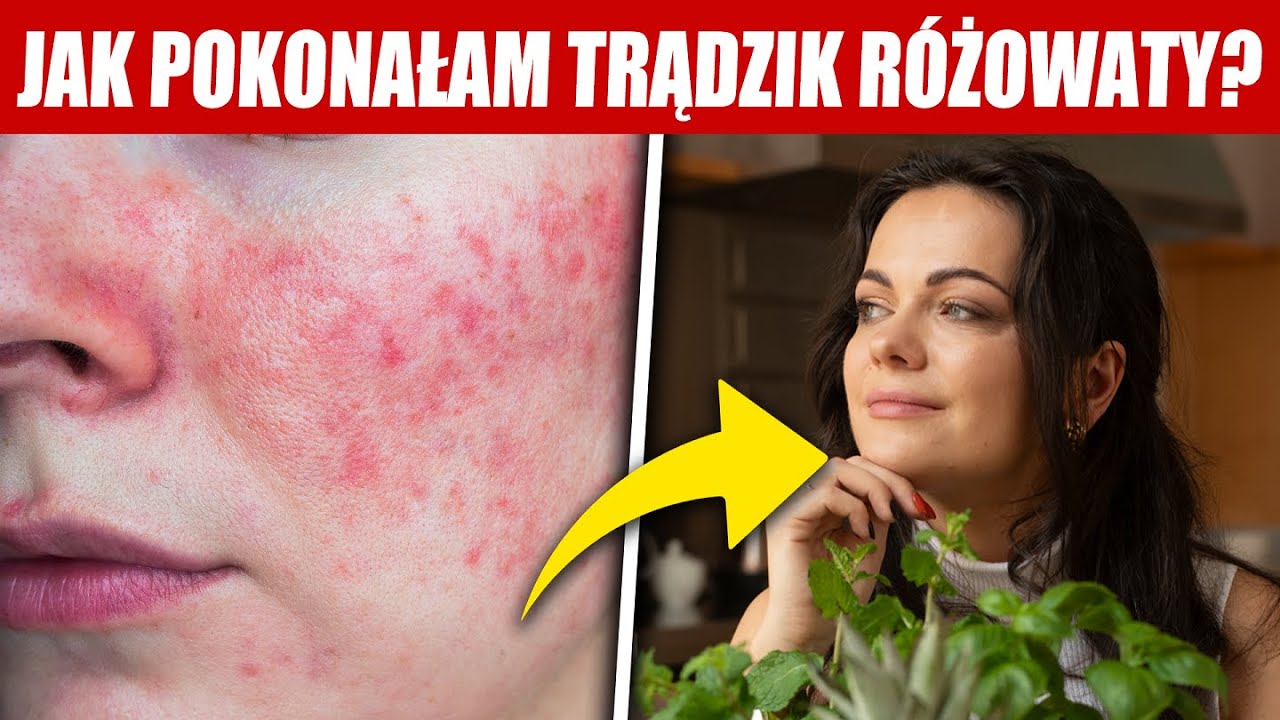To mi pomogło w walce z trądzikiem różowatym