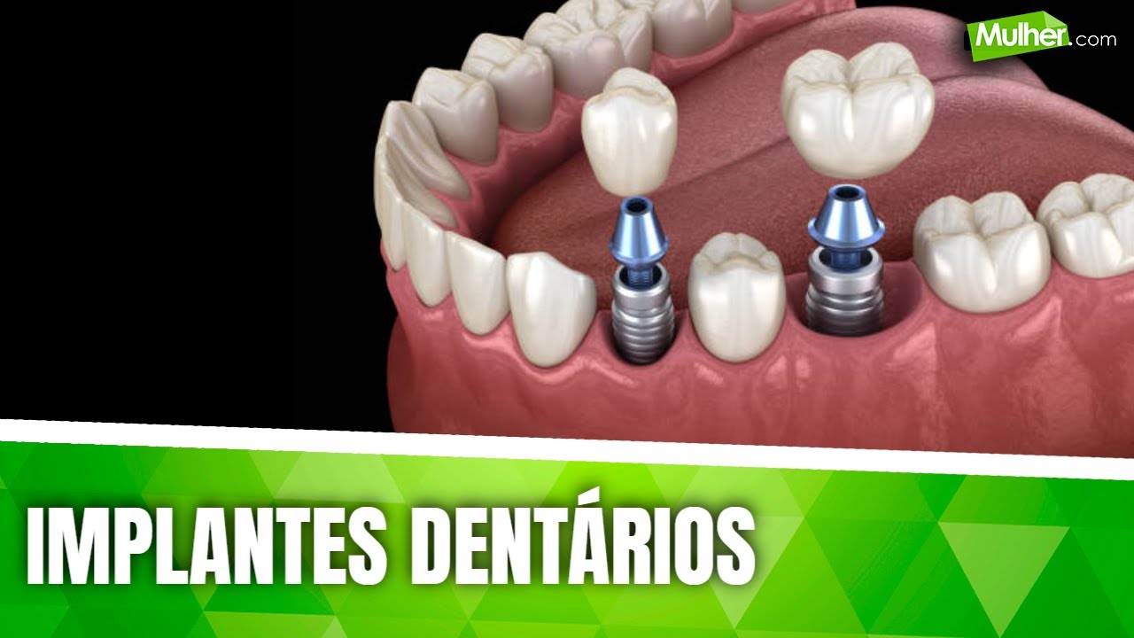 Implantes dent&aacute;rios: descubra o que &eacute; mito e o que &eacute; verdade