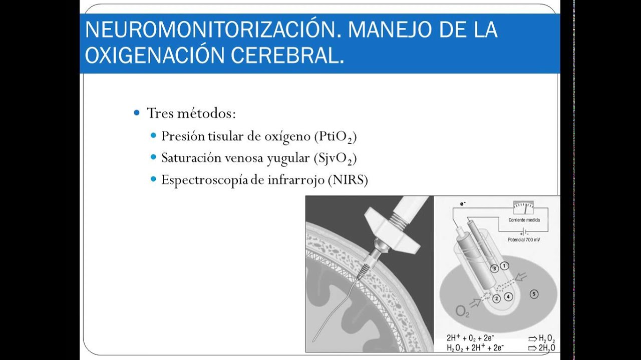 Neuromonitorizaci&oacute;n multimodal y fisiopatolog&iacute;a del TCE grave
