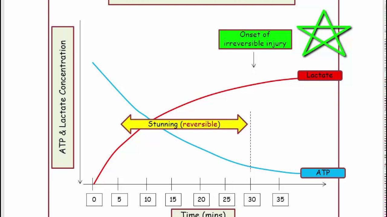12DaysinMarch, ASHD#4: Cardiac Pathology of Myocardial Infarction for the USMLE Step One Exam