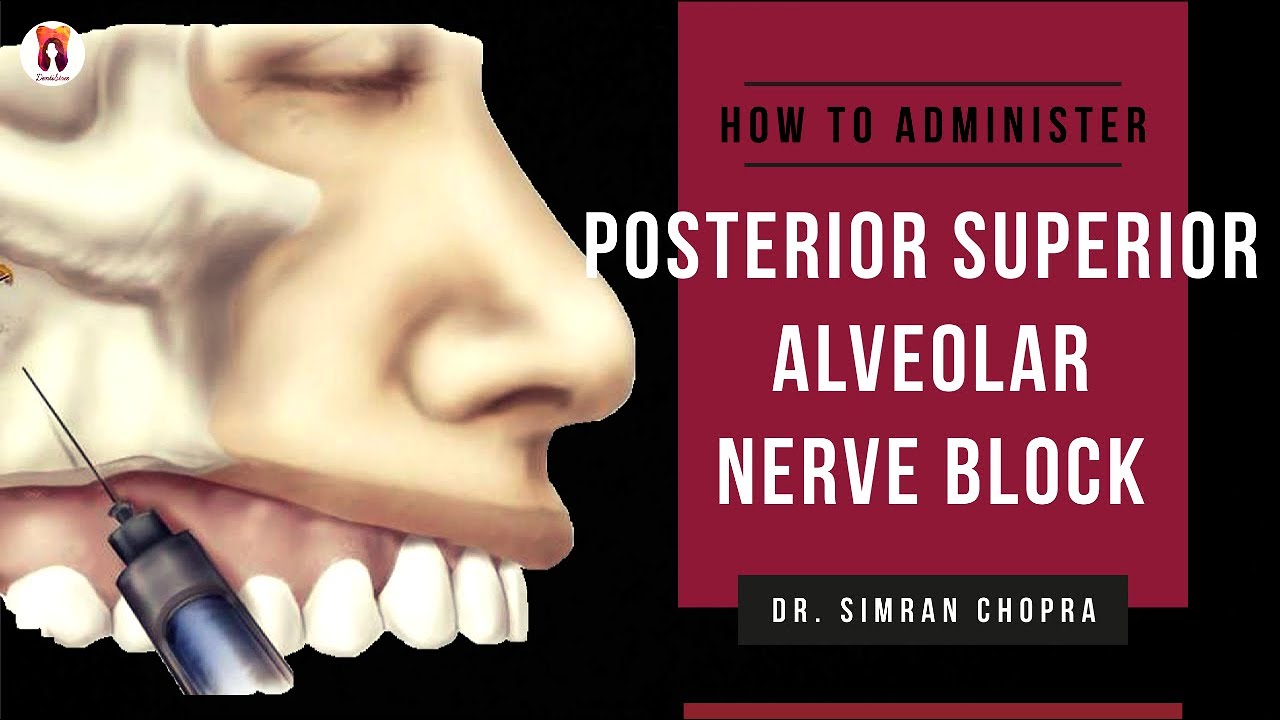 Posterior Superior Alveolar Nerve Block l  PSA Nerve Block Technique l Nerve Block Injection