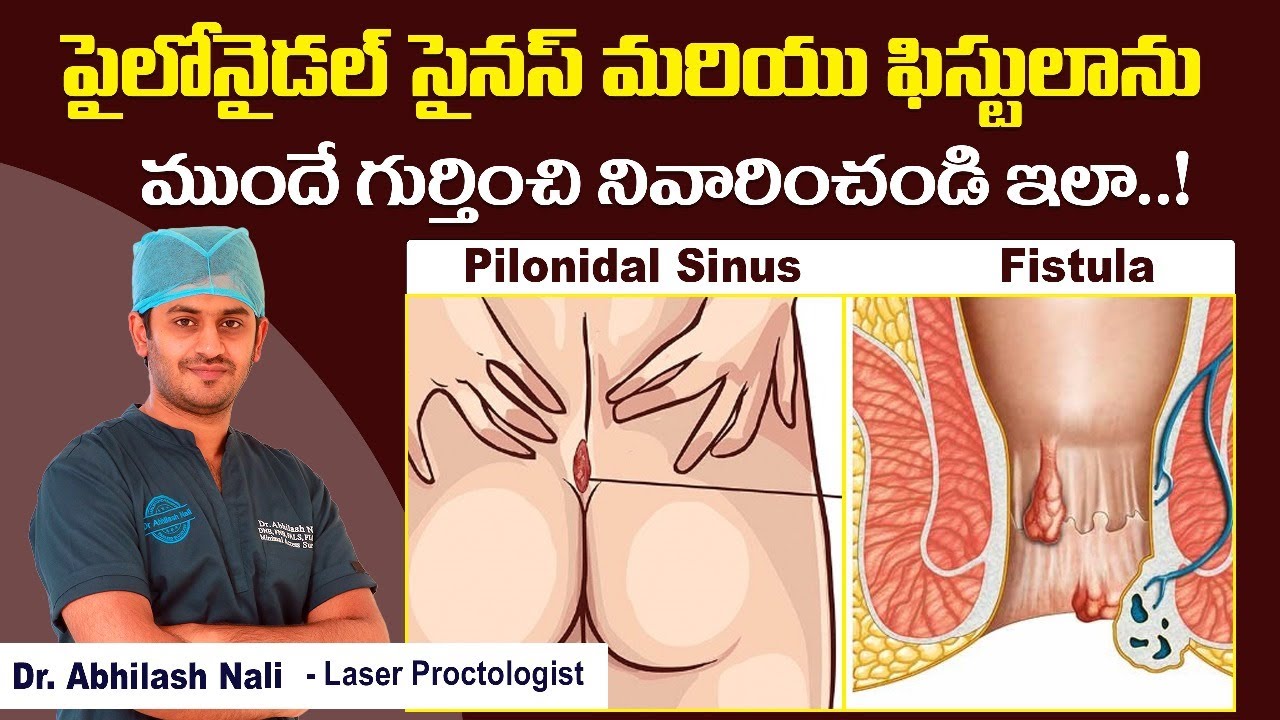 Difference Between Pilonidal Sinus and Anal Fistula || Pilonidal Sinus Symptoms || Dr Abhilash Nali
