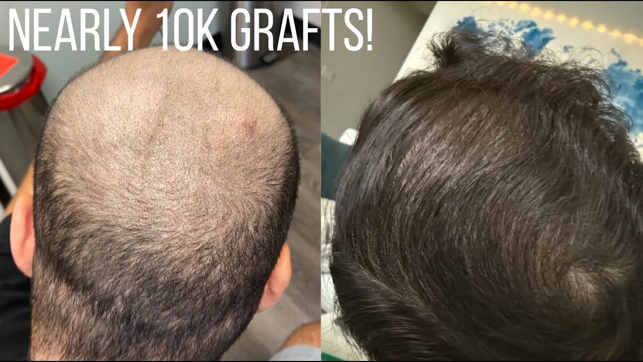 2nd FUT/FUE Combo Hair Transplant - 3.5 Month Update - Dr. Ted Miln, 3400 grafts (crown)