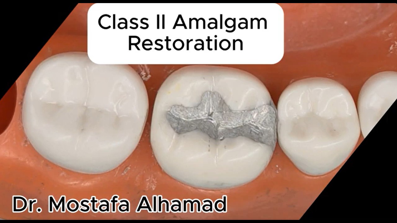Class II amalgam restoration