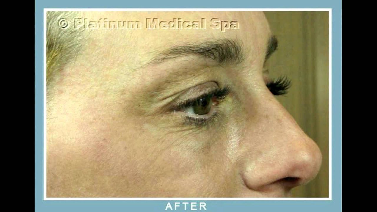 Laser Resurfacing Orange County | Orange County Spa