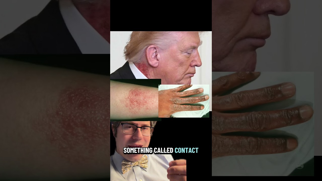 What&rsquo;s the rash on President Trump&lsquo;s neck? For general educational purposes only.#rash#trump#doctor