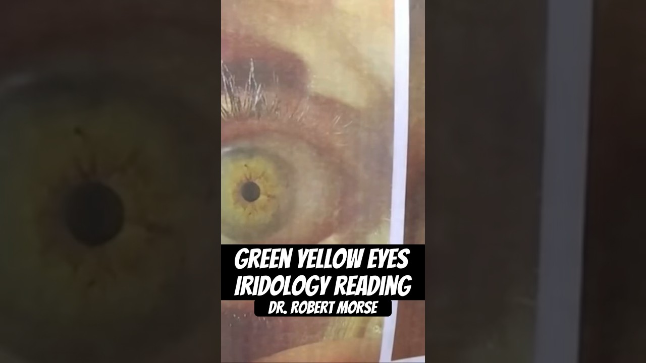 What does your eye color tell you? #iridology #lymphaticdrainage #healthydiet #brain