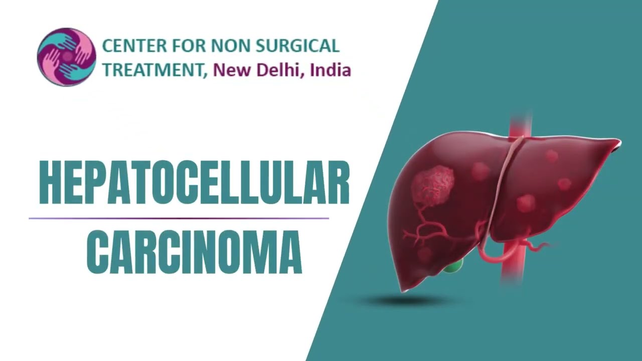 Hepatocellular Carcinoma