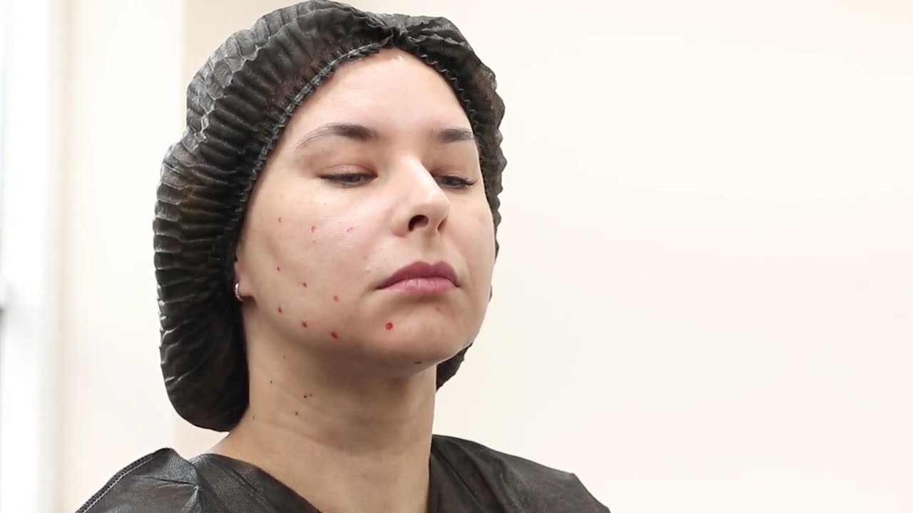 SuneKOS Performa Обличчя - протокол інєкцій Fullface