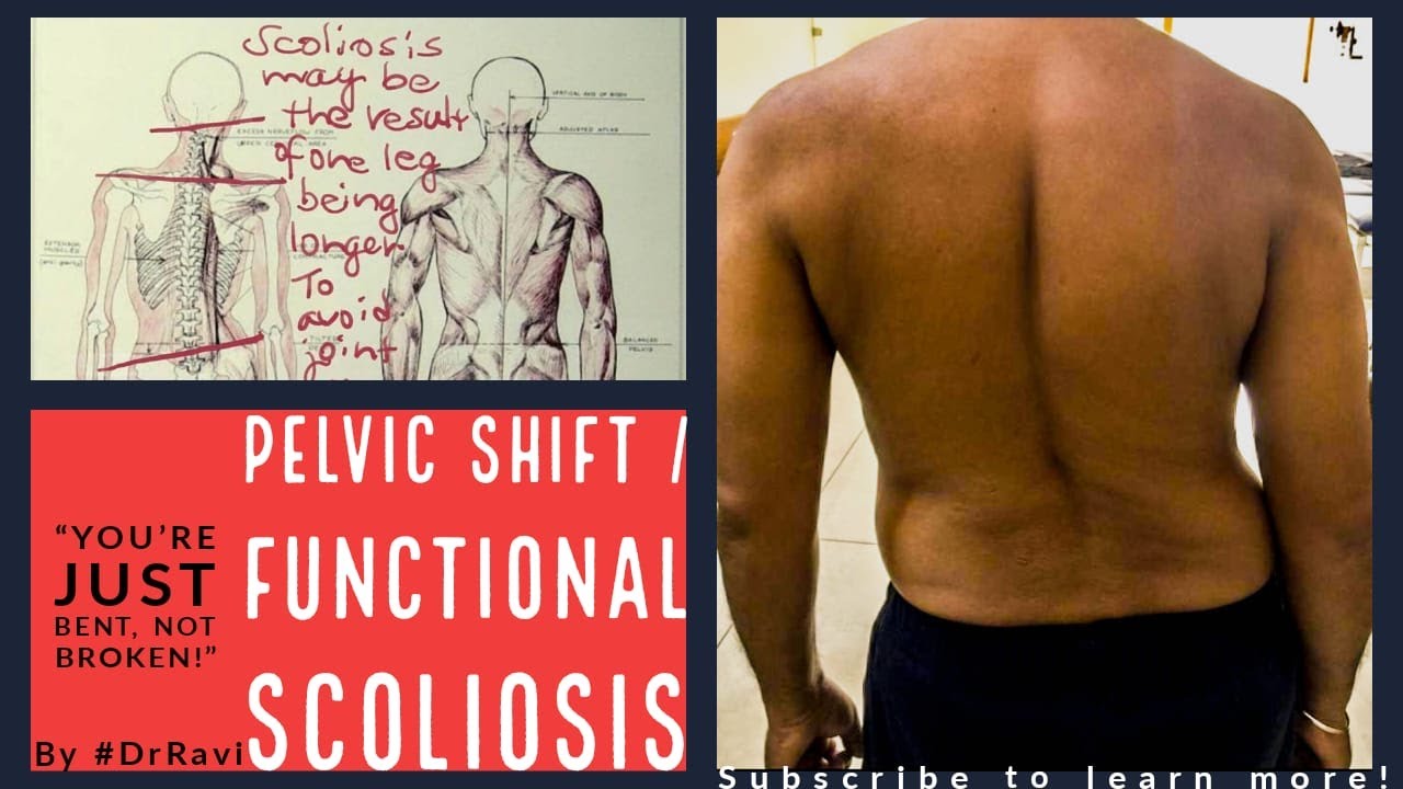 Overcoming from Functional Scoliosis After One Treatment Session By DrRavi