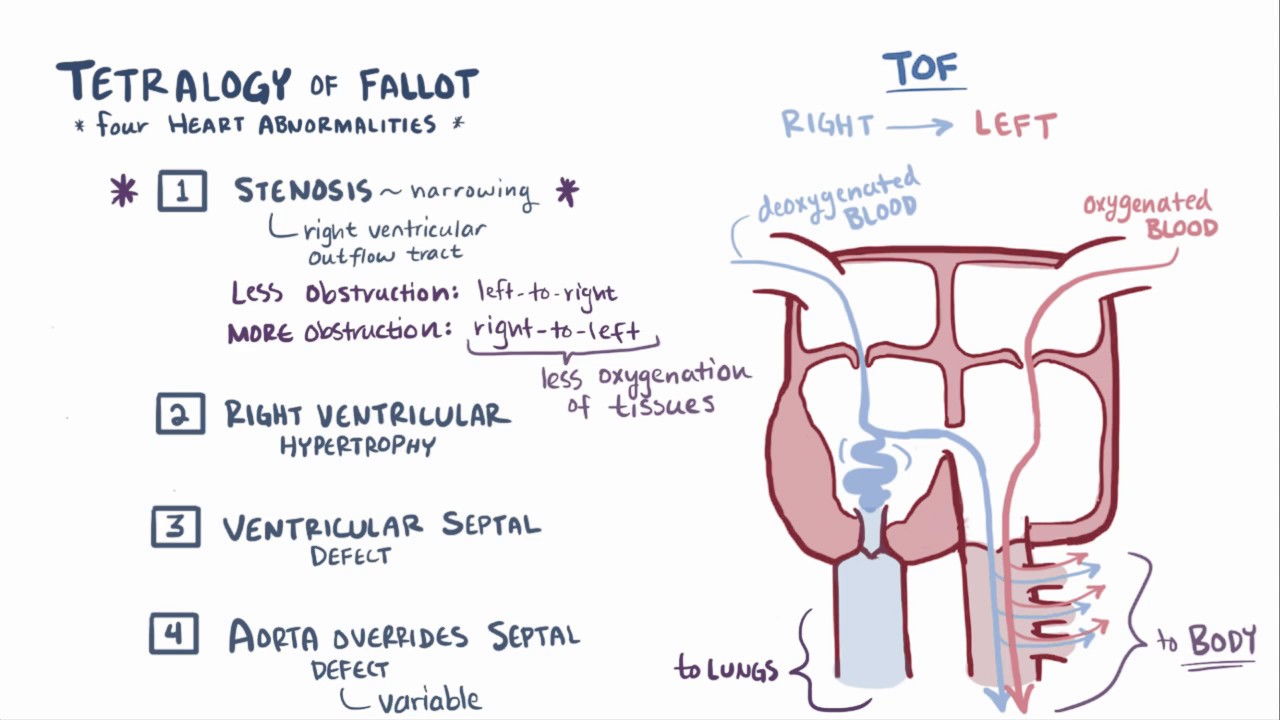 Tetralogy of fallot TOF   repair, causes, symptoms & pathology