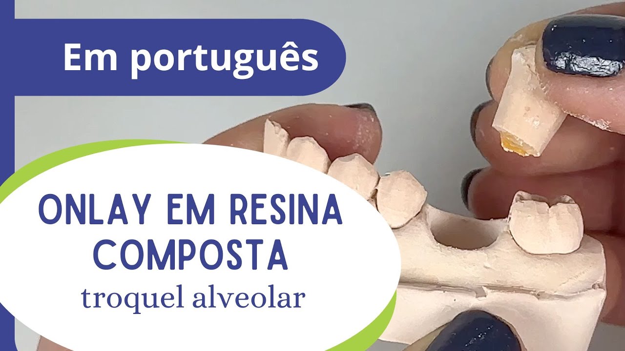 Onlay em resina composta - parte 3: troquel alveolar.