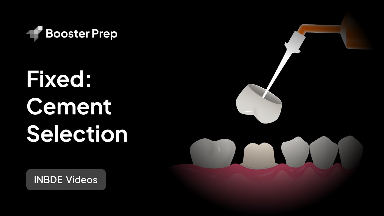 Prosthodontics | Fixed: Cement Selection | INBDE, NDEB, ADAT
