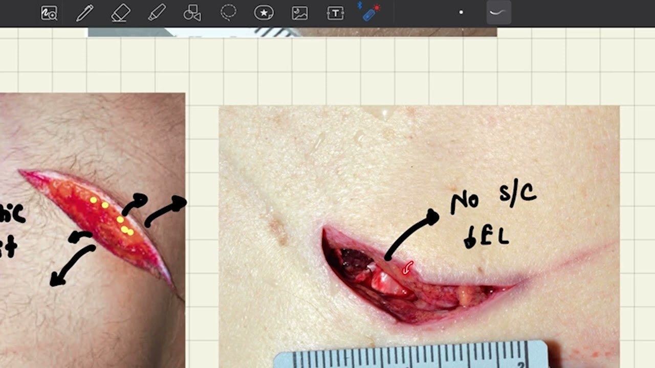 Brief Discussion on Incised wound