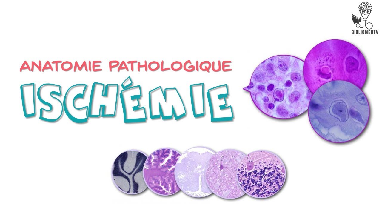Anatomie Pathologique - Ischémie