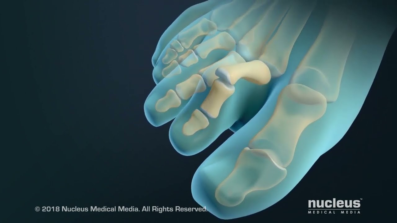 Hammertoe and Claw Toe Correction