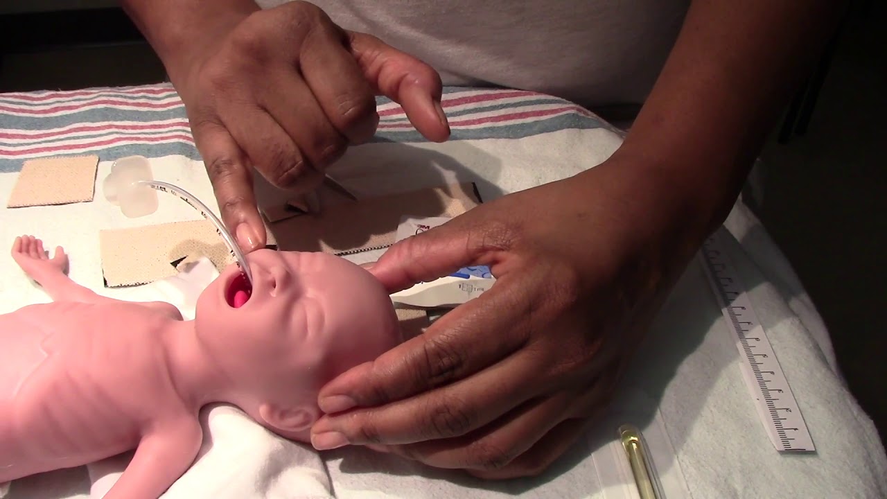 Securing the Neonatal ET Tube