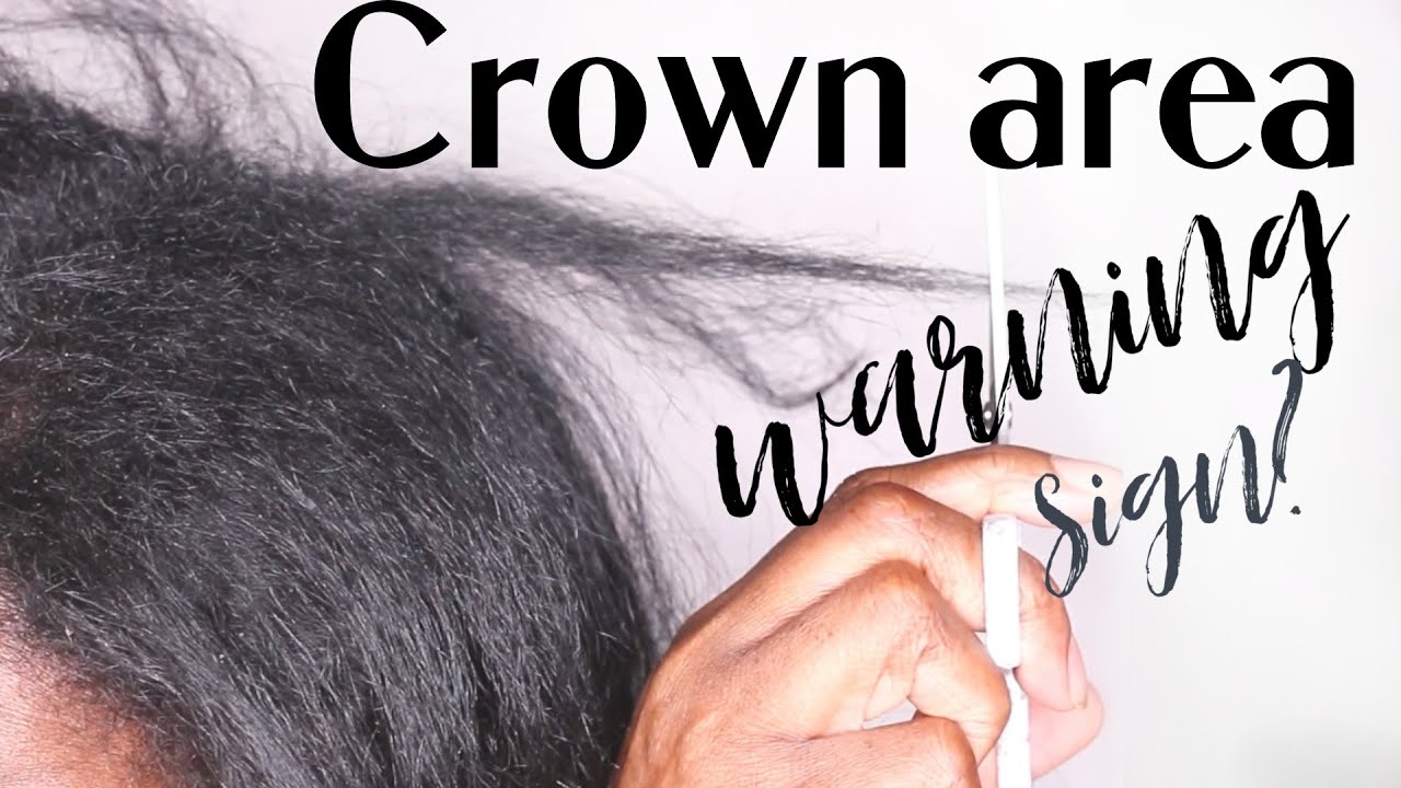 Look what ALOPECIA did to my CROWN AREA 1 month before my  HAIR LOSS.