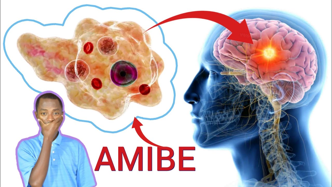 Ibimenyetso bibi bihamya ko urwaye inzoka ya amibe. Ifashishe ibi bintu.
