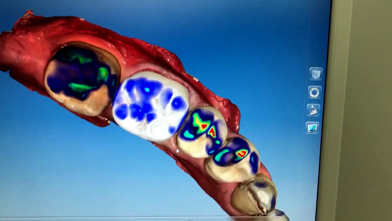 Cerec Sirona - Demo scansione 3D con il software CAD/CAM Cerec