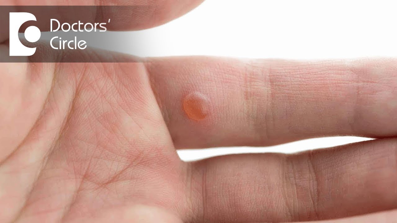 Possible causes of 'White hard bumps' on hands & fingers with its management - Dr. Rasya Dixit