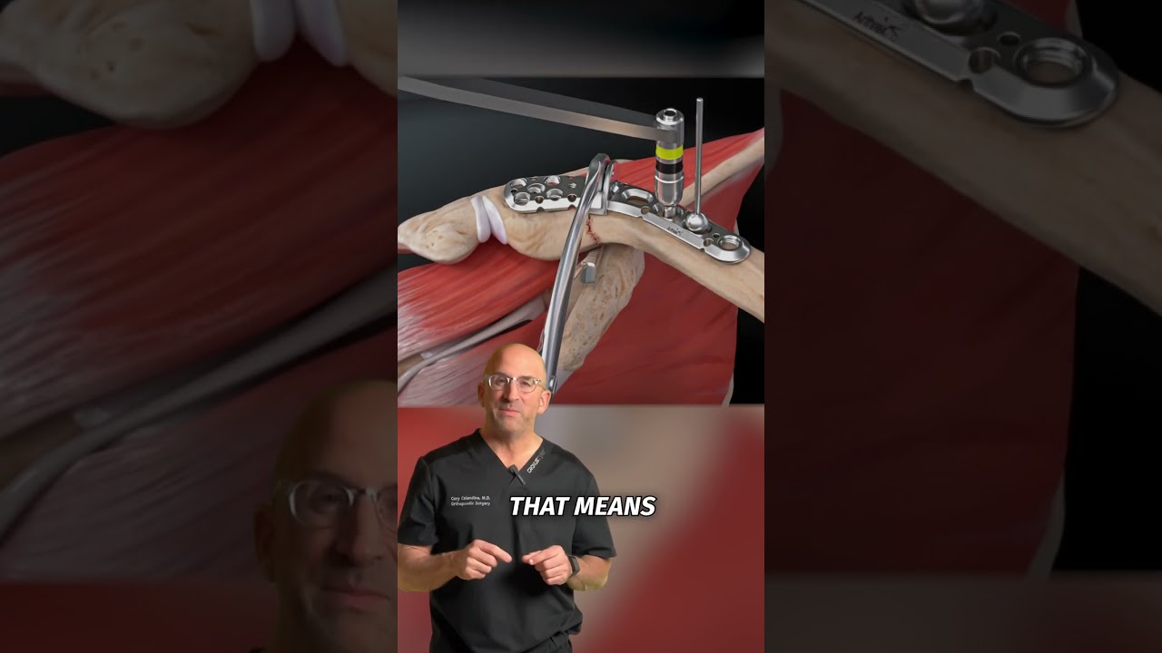 Collare Bone Plate and Screws #shorts