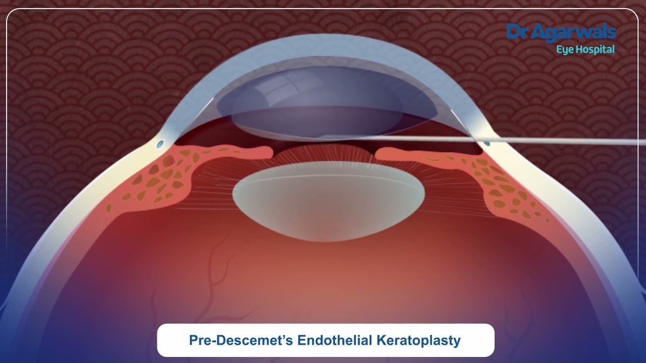 PDEK Corneal Transplant Explained | Dr Preethi Naveen | Dr Agarwals Eye Hospital