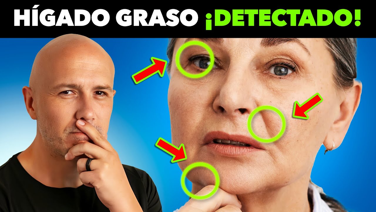 ¡TODAS Las Personas Que Tienen HÍGADO GRASO Tienen ESTO En Común! Signo OCULTO Que DEBES Conocer