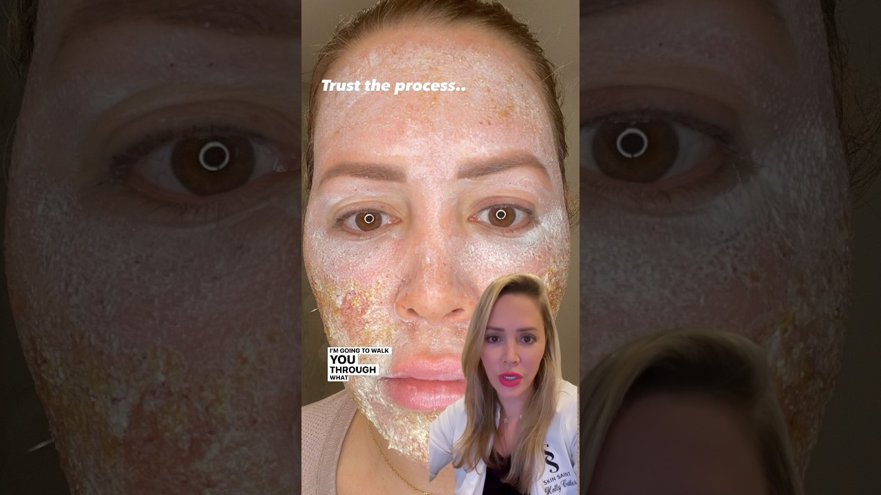 A DEEP Laser Treatment Did This!?