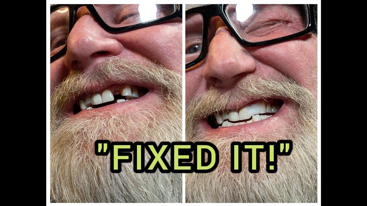I Fixed My Missing Tooth for $8 (The Straightforward Truth)