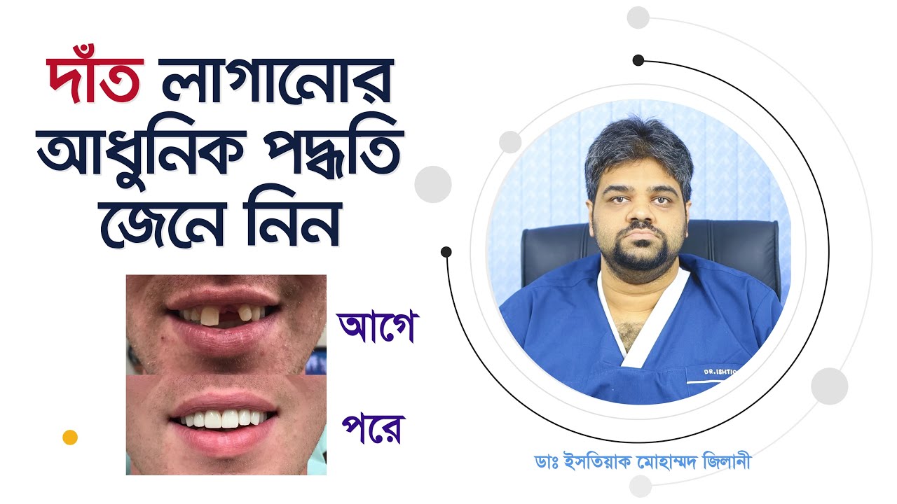 নতুন দাঁত লাগানোর আধুনিক উপায় জানুন। Dental Implants Procedure, Cost, Types, Problems & Safe