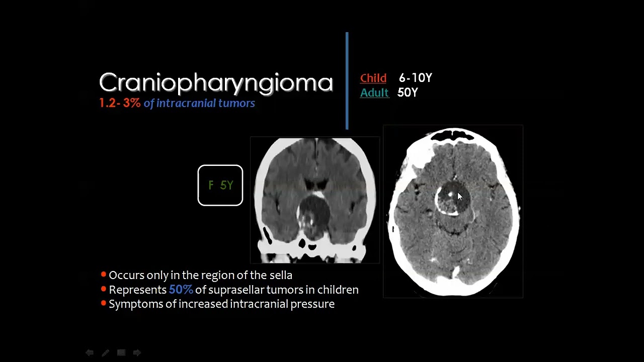 Pediatric imaging, Brain tumors II DRE Prof  Mamdouh Mahfouz HD