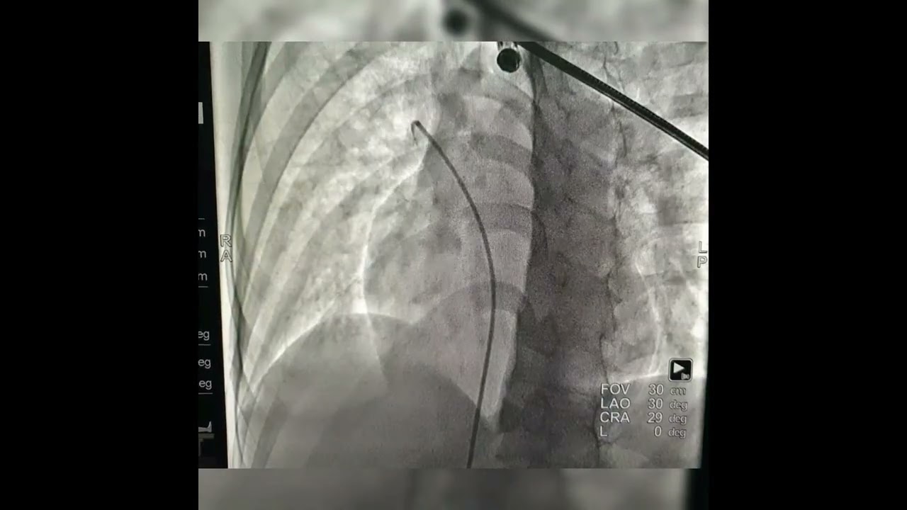 Prosedur Tindakan Tutup ASD (Atrial Septal Defect) pada pasien PJB 🫀