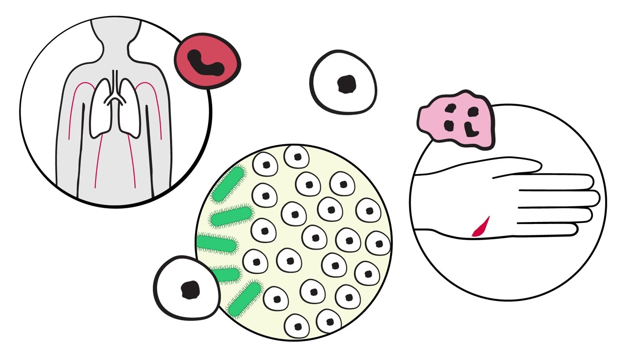 Cancer Basics &ndash; What is acute leukemia?