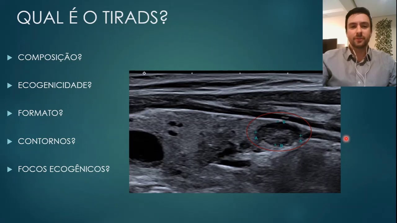 QUAL &Eacute; O TIRADS?