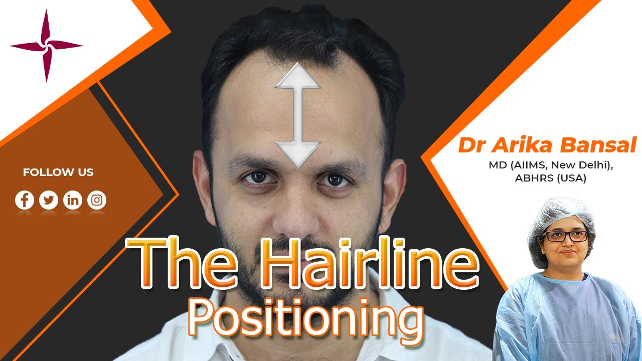 How To Determine The Right Hairline Positioning By Dr Arika Bansal At @EugenixHairSciencesofficial