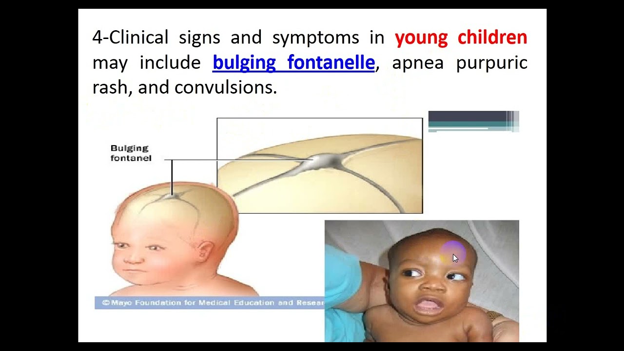 CNS Infections 2024 By Dr  Dheyaa Jabbar