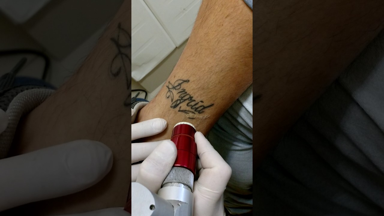 Remoção de tatuagens a laser (Nd Yag Q-Switched).