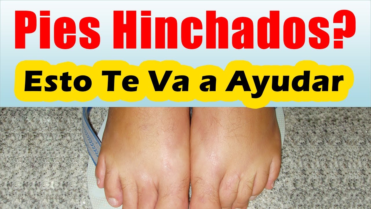 COMO BAJAR LA HINCHAZON DE LOS PIES Remedios Para Los Pies Inchados COMO DESINFLAMAR LOS PIES
