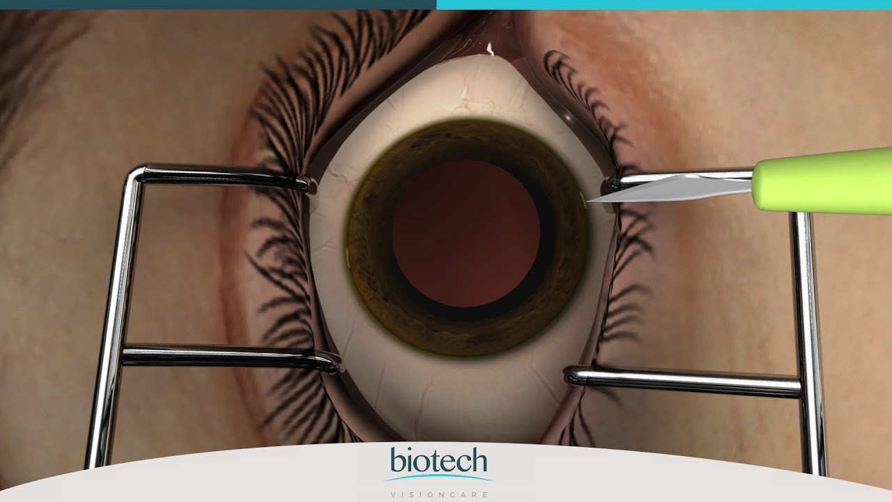 Eyecryl PHAKIC IOL: диапазон загрузки и имплантации