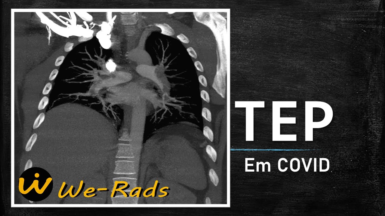 TEP em COVID