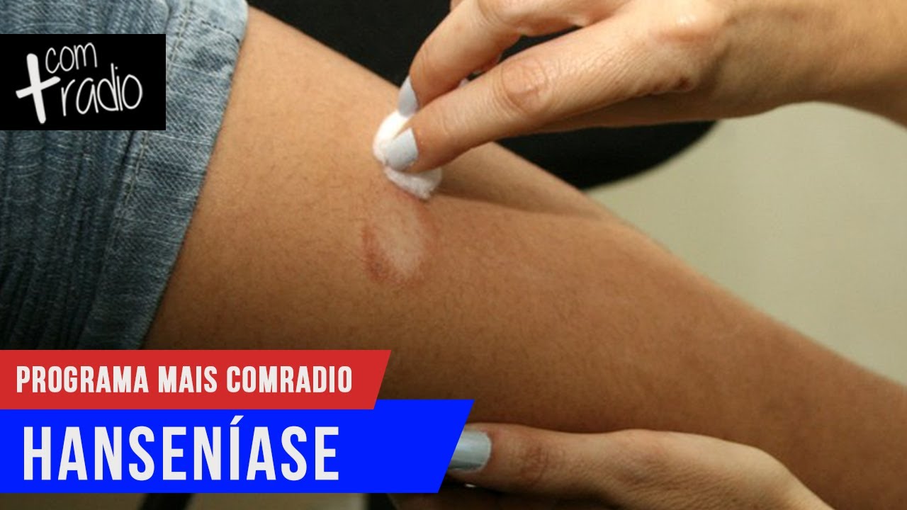 Hansen&iacute;ase | Mais Comradio