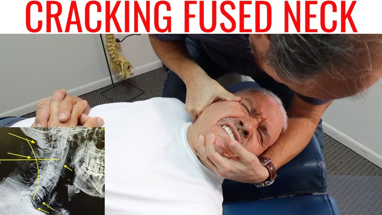 Severe Neck Arthritis Pain Relief by Chiropractor