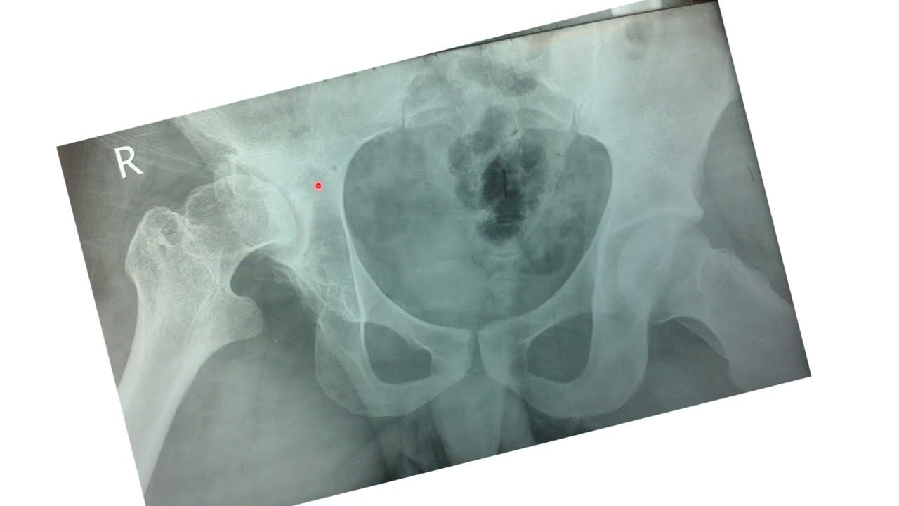 TOTAL HIP REPLACEMENT FOR ACETABULAR DYSPLASIA